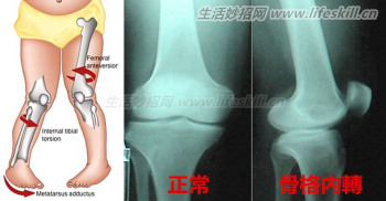 千万不可让孩子“鸭子坐”!这种坐姿会严重影响孩子的骨骼发育!